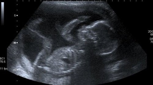 scanningsbillede af det ufødte barn