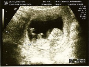 Innovative teknikker til at opdage graviditetskomplikationer