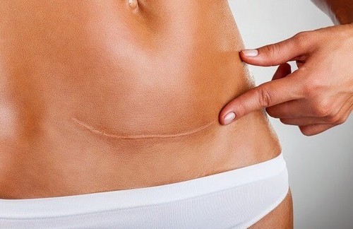 ar på kroppen efter kejsersnit