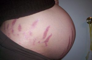Strækmærker under graviditet - hvorfor?