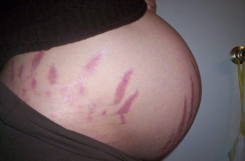 Strækmærker under graviditet – hvorfor?