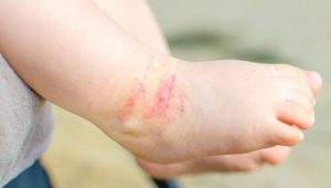 Atopisk eksem: 15 gode tips til at slippe af med det