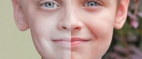 meget bleg hud kan være et tegn på leukæmi