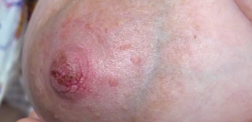 ømme og revnede brystvorter