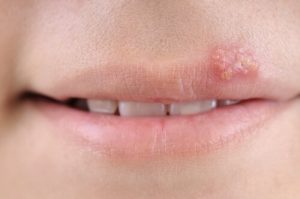 Herpes hos børn: Symptomer, årsager og behandling