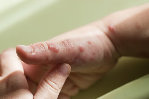 Herpes på hånden hos nyfødt