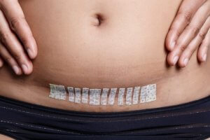 At blive mor efter en hysterektomi