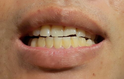 Fremkomsten af plamager på permanente tænder