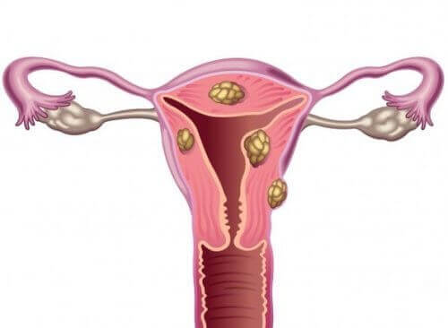 Fibromer og infertilitet hos gravide kvinder
