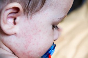 Fødevareallergier hos børn: De mest almindelige