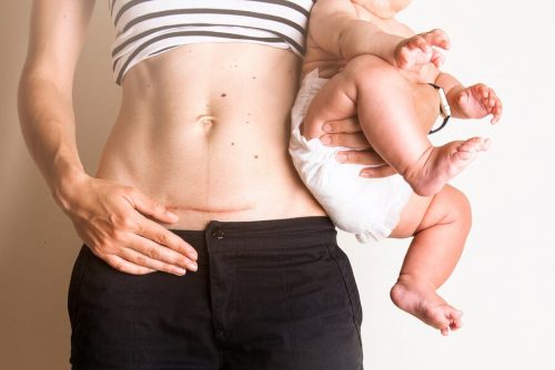 Pleje af postpartum sting