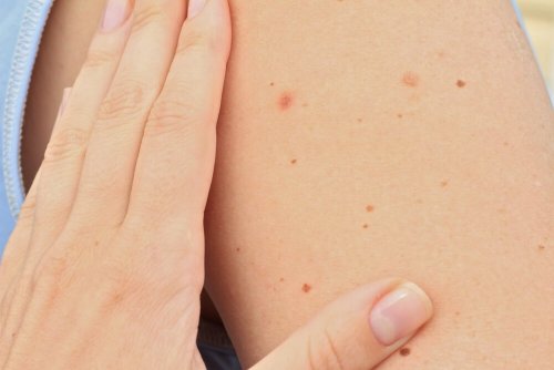 arm med modermærker