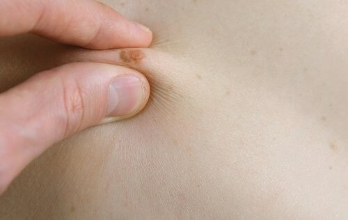 modermærke på hud