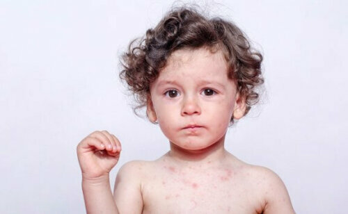 Allergi overfor sved hos børn
