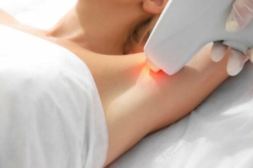 Kan du få fjernet hår med laser, hvis du er gravid?