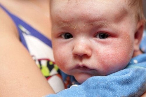 Baby med eksem