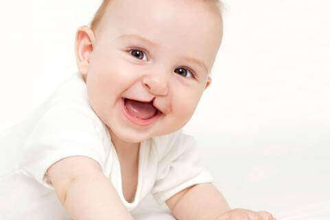 Baby med læbe-ganespalte 