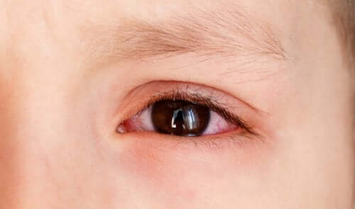 Årsager til røde øjne hos børn