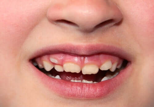 Skæve tænder hos børn: Hvad skal jeg gøre?