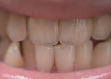 Kan fluorid misfarve børns tænder?