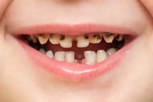 Barn med huller i tænderne