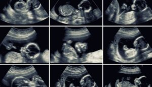 Misdannelsesscanning: Hvorfor er den så vigtig?