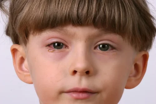 Barn med øjenbetændelse, hvilket kan undgås ved at vaske hænder