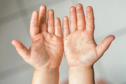 Udslæt på hænder viser hånd-, fod- og mundsyge