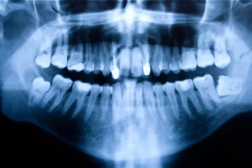 Røntgen af tænder