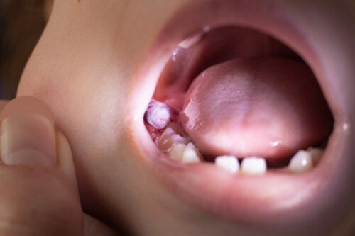Tandcyster hos børn: Hvordan man behandler dem