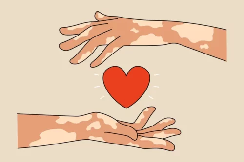 To hænder med vitiligo holder om hjerte