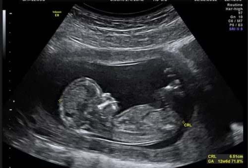En ultralydsscanning af baby