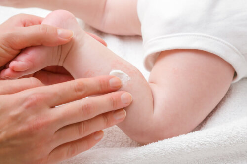 Baby med reaktiv hud får creme på