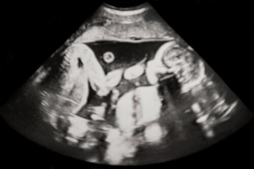Scanning af flerfoldsgraviditet