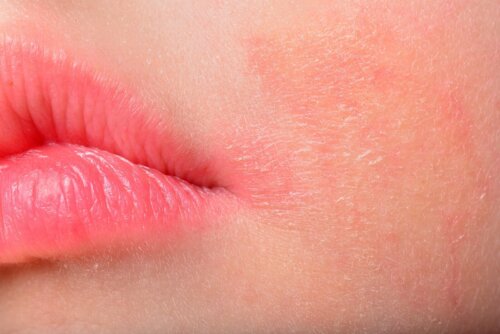 Eksempel på hudmykoser hos børn