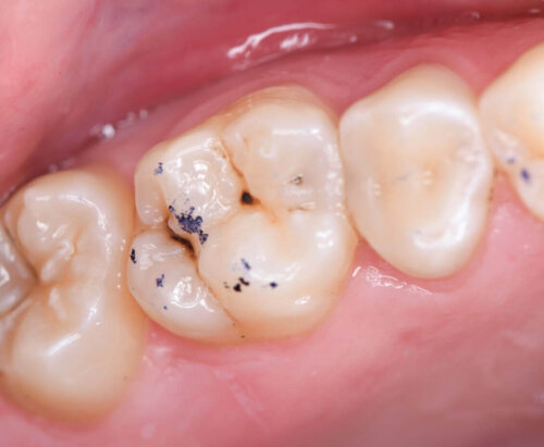 Eksempel på pletter på børns tænder