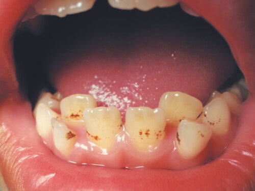 Pletter på børns tænder på grund af jerntilskud