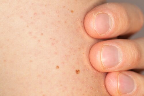 Hvordan plejer man huden hos børn med keratosis pilaris?