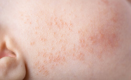 Eksempel på talgknopper hos nyfødte