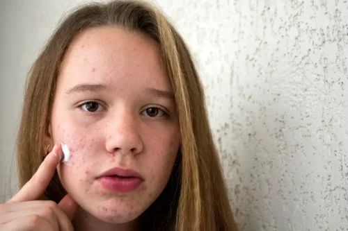 Teenagepige med akne smører creme på ansigtet