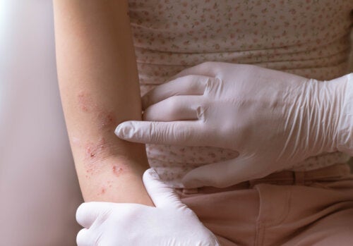 De 10 mest almindelige hudproblemer i det første leveår