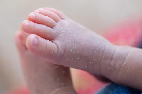 Eksempel på tør hud hos babyer