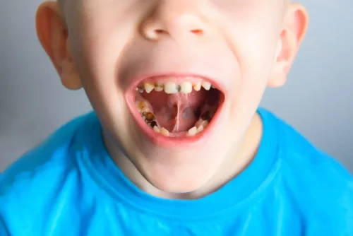 Barn har huller i tænderne