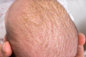 Hvordan kan man fjerne arp hos babyer?