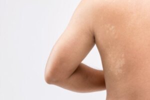 Pityriasis versicolor hos babyer og børn