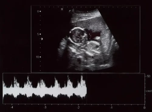 Eksempel på ultralydsscanning under graviditet